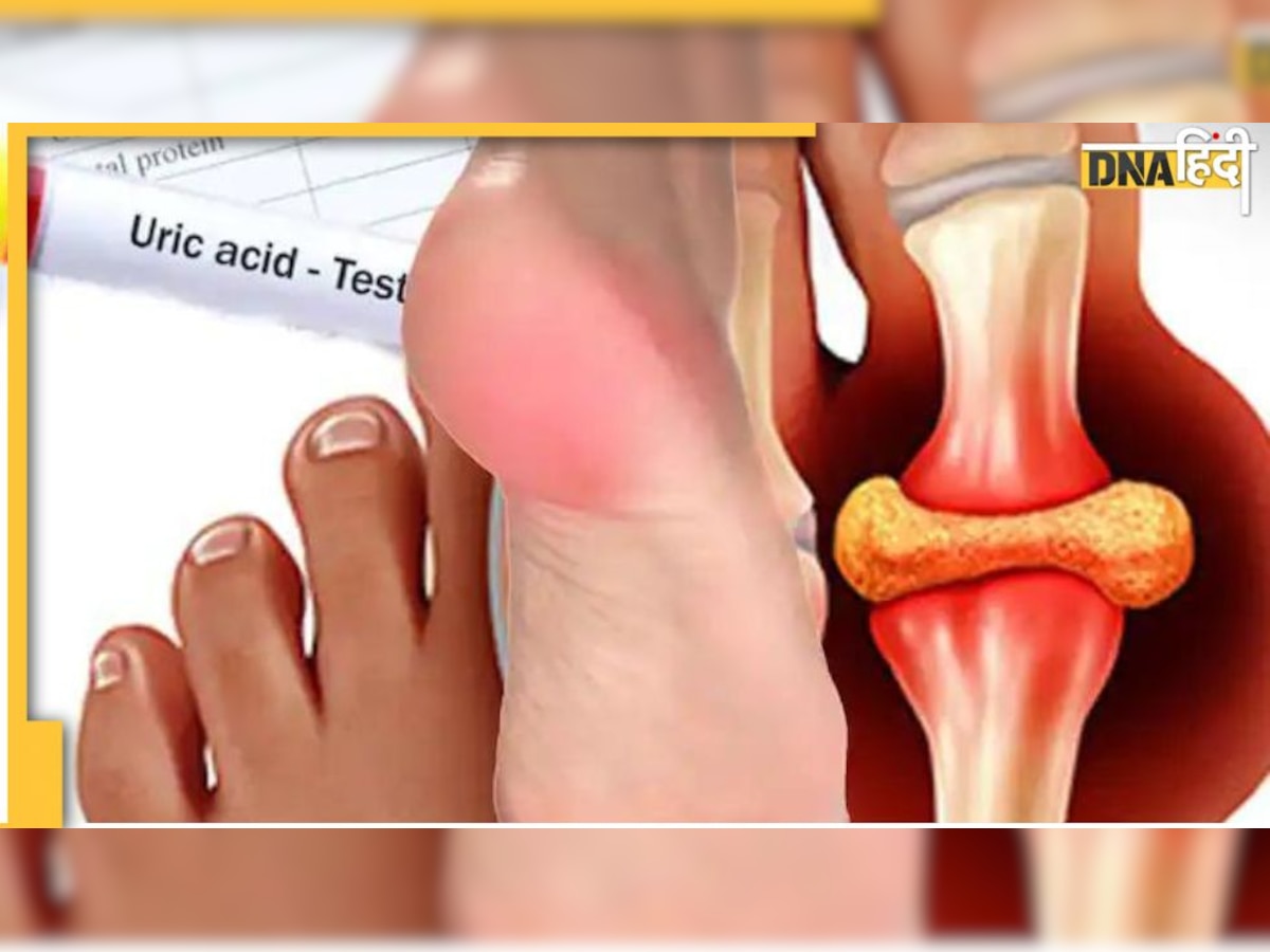 Home Remedies for High Uric Acid: इन Ayurvedic इलाज को अपनाने से छू मंतर हो जाएगा दर्द