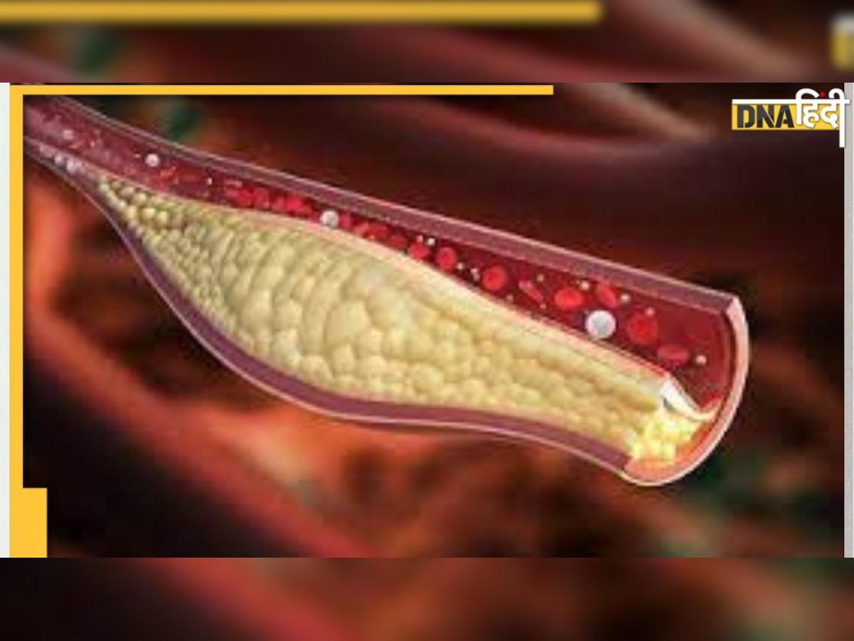 High Cholesterol Sign: पुरुषों में ये 2 संकेत आते हैं नज़र, तो समझ लें नसों में वसा है खतरे के निशान पर