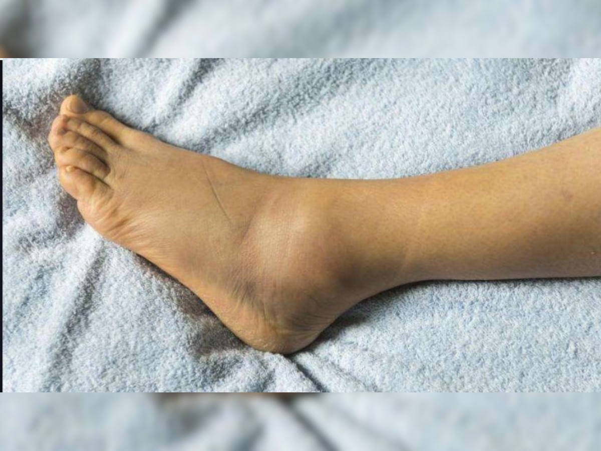 Causes of swelling in body: इन 5 बीमारियों का संकेत है शरीर में सूजन