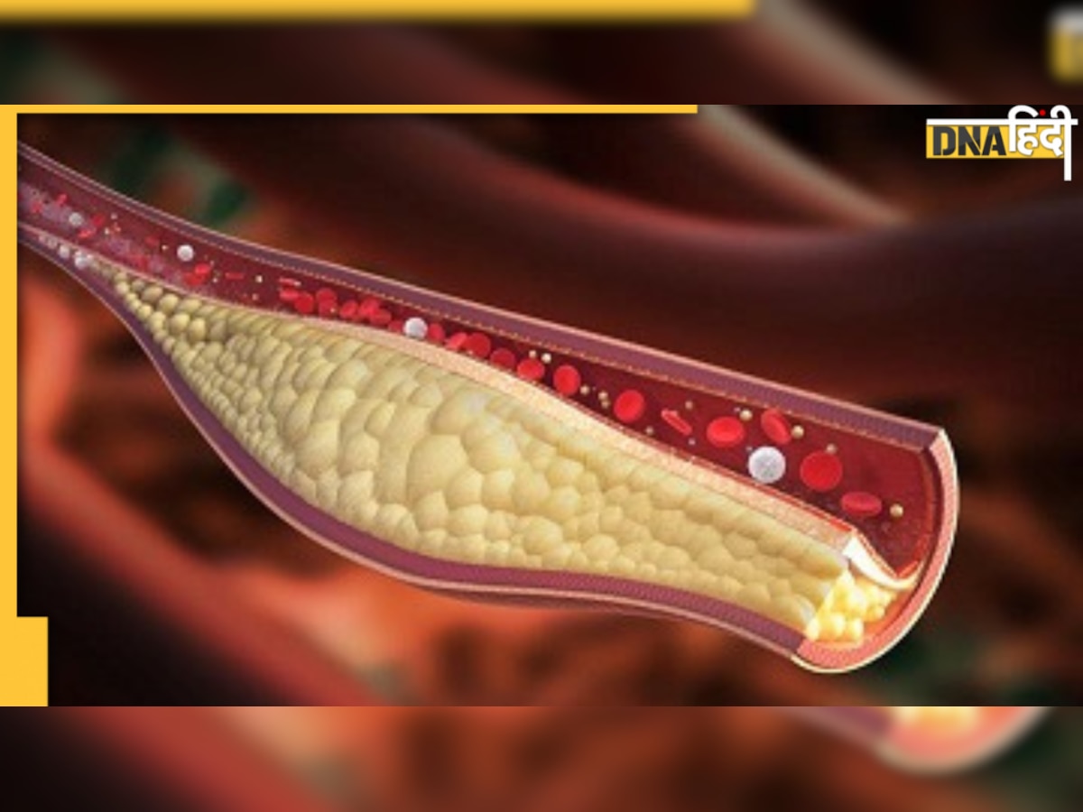 पैरों में सूजन के ये 3 संकेत बताते हैं Cholesterol से ब्लॉक हो चुकी हैं नसें