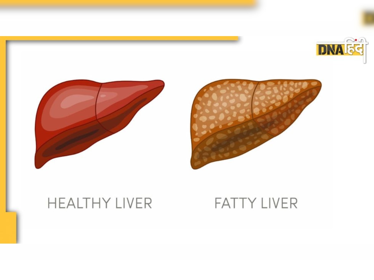 पेट की ये 2 परेशानी नॉन अल्कोहलिक Fatty liver का देती है संकेत