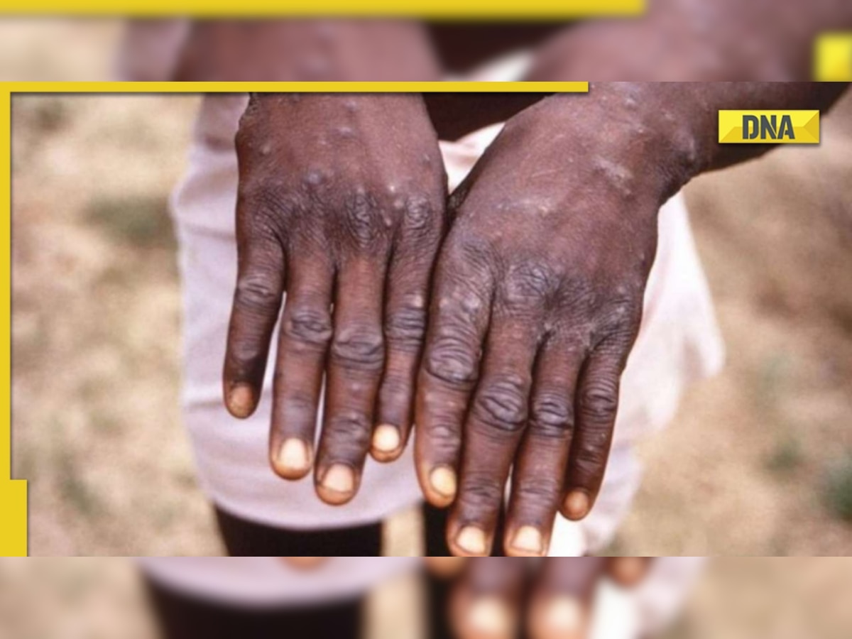 Monkeypox presently not a global health emergency, but an evolving threat: WHO