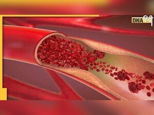  Foods Clog Arteries: इन 5 चीजों की वजह से फट सकती हैं दिमाग की नसें