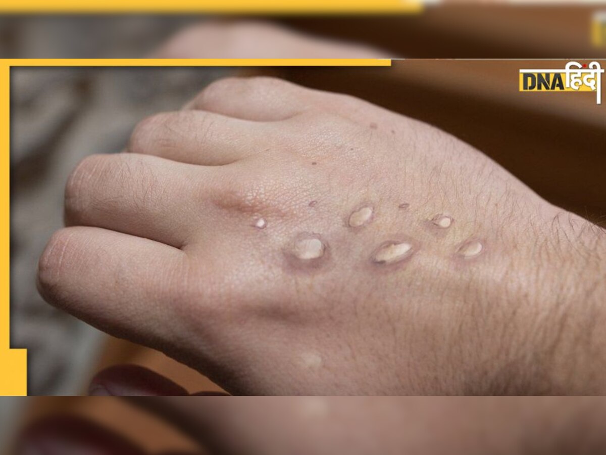 Monkeypox: इन चार लक्षणों से समझिए कैसे आपके शरीर में फैल जाएगा मंकी पॉक्स