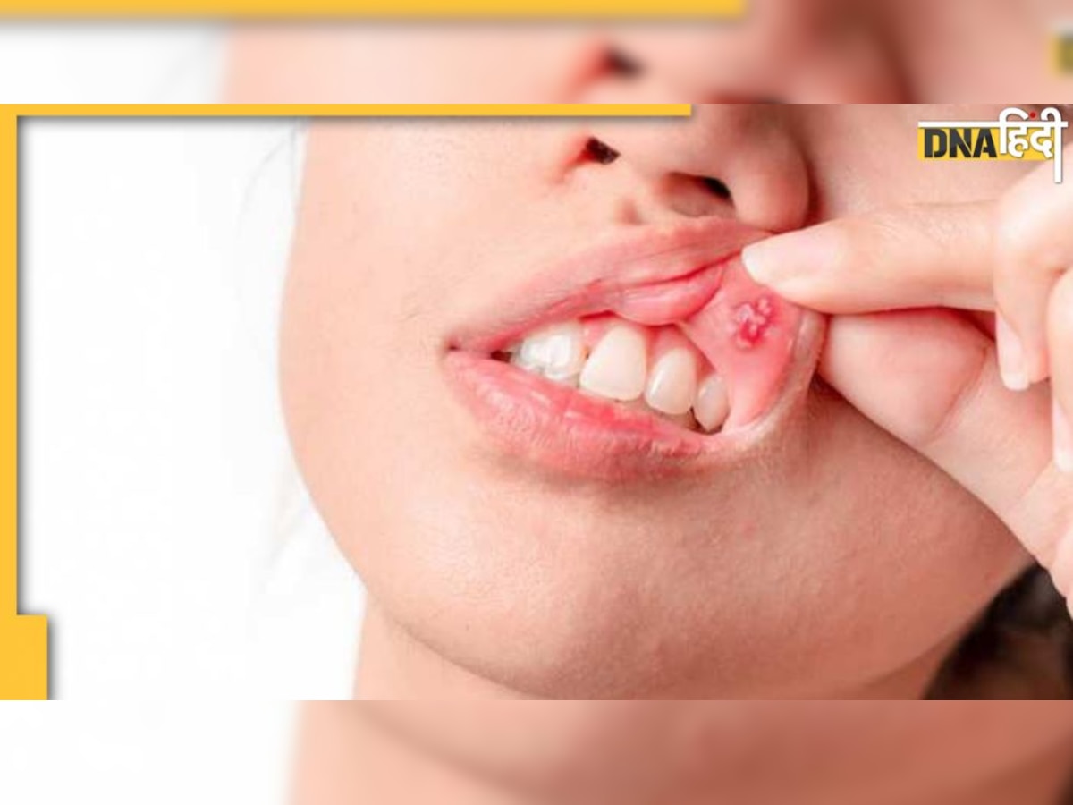 Mouth Ulcer Home Remedy: इन 5 गंभीर बीमारियों का संकेत है मुंह में छाले