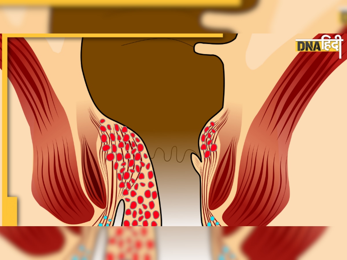 Piles: इस बीमारी से राहत दिलवा सकती है यह ज़बर्दस्त Home Remedy, डाइट चार्ट भी करें फॉलो