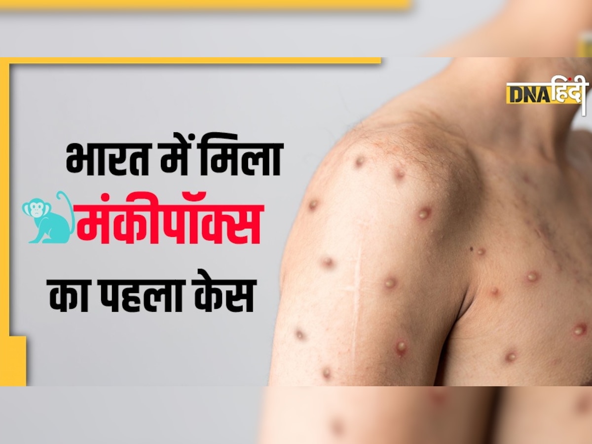 Monkeypox Case: भारत में मिला मंकीपॉक्स का पहला मरीज, जानें, इस बीमारी के बारे में सबकुछ 