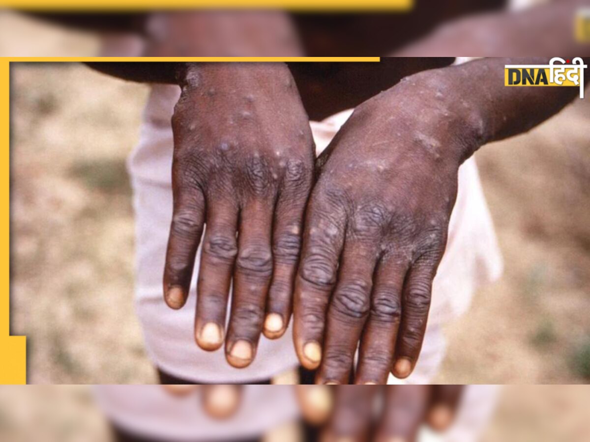 Monkeypox Prevention: अगर आपने लगाया है चेचक का टीका तो इस वायरस से न घबराएं, ये हैं बचाव के और तरीके 