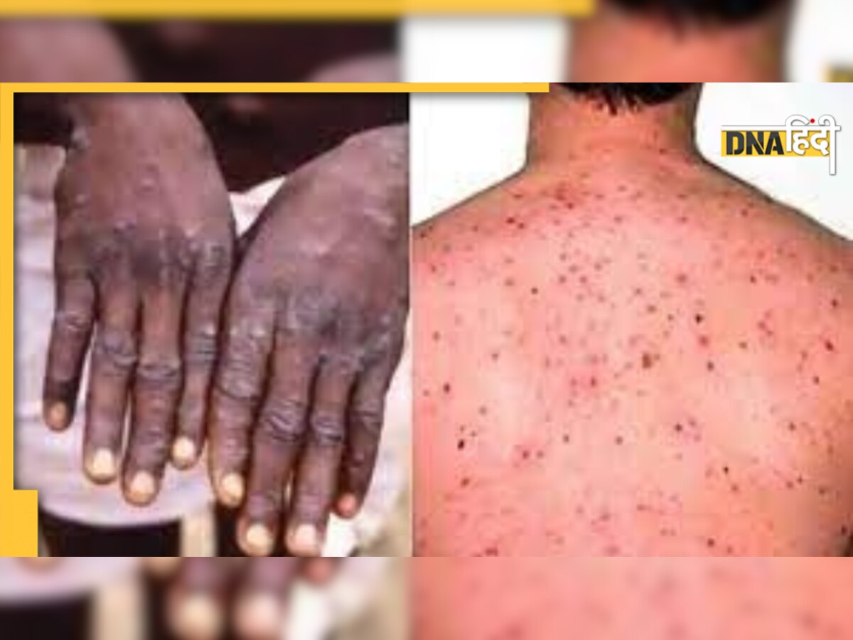 Monkeypox Cases in India: भारत में पाया गया पहला केस, Insurance Policy से हो सकेगी मरीजों और यात्रियों की मदद