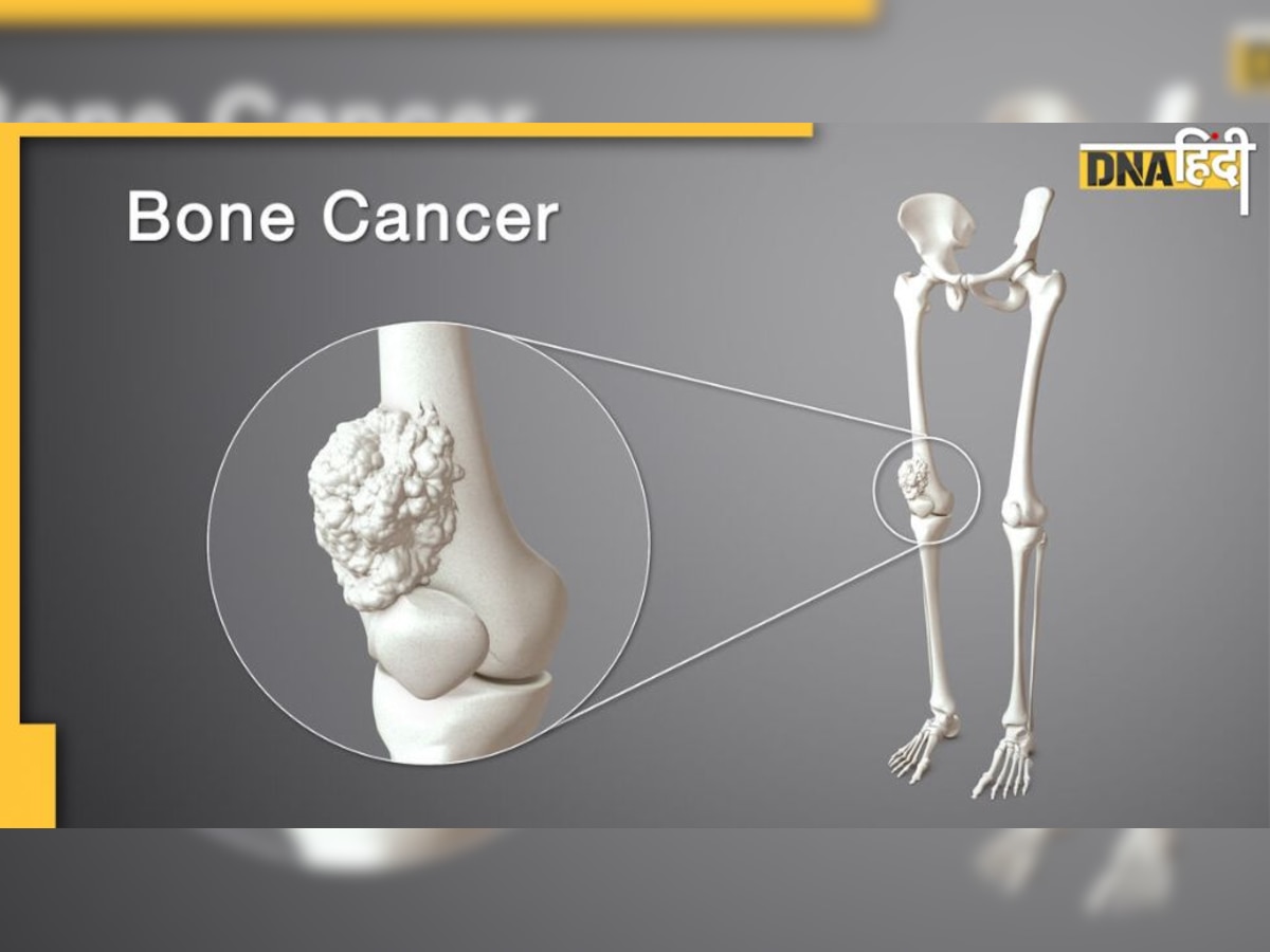 Bone Cancer: अगर हड्डियों में शुरू में ही दिखें ये कुछ लक्षण तो तुरंत हो जाएं अलर्ट, बड़ी बीमारी का संकेत तो नहीं