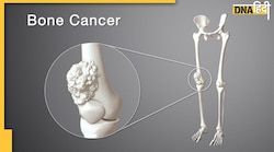 Bone Cancer: अगर हड्डियों में शुरू में ही दिखें ये कुछ लक्षण तो तुरंत हो जाएं अलर्ट, बड़ी बीमारी का संकेत तो �नहीं