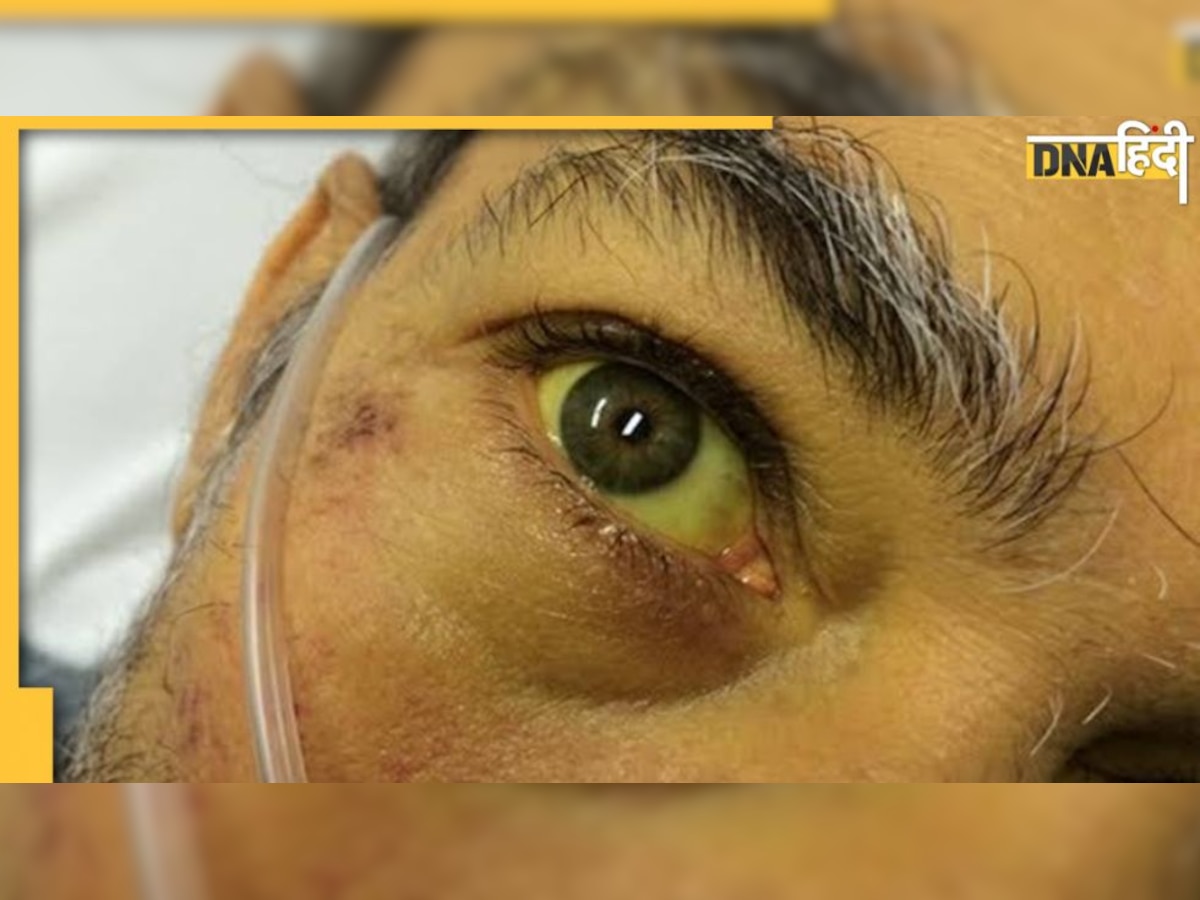 पीलिया जब 'Black Jaundice' में बदलने लगता है, नज़र आते हैं ये 10 लक्षण