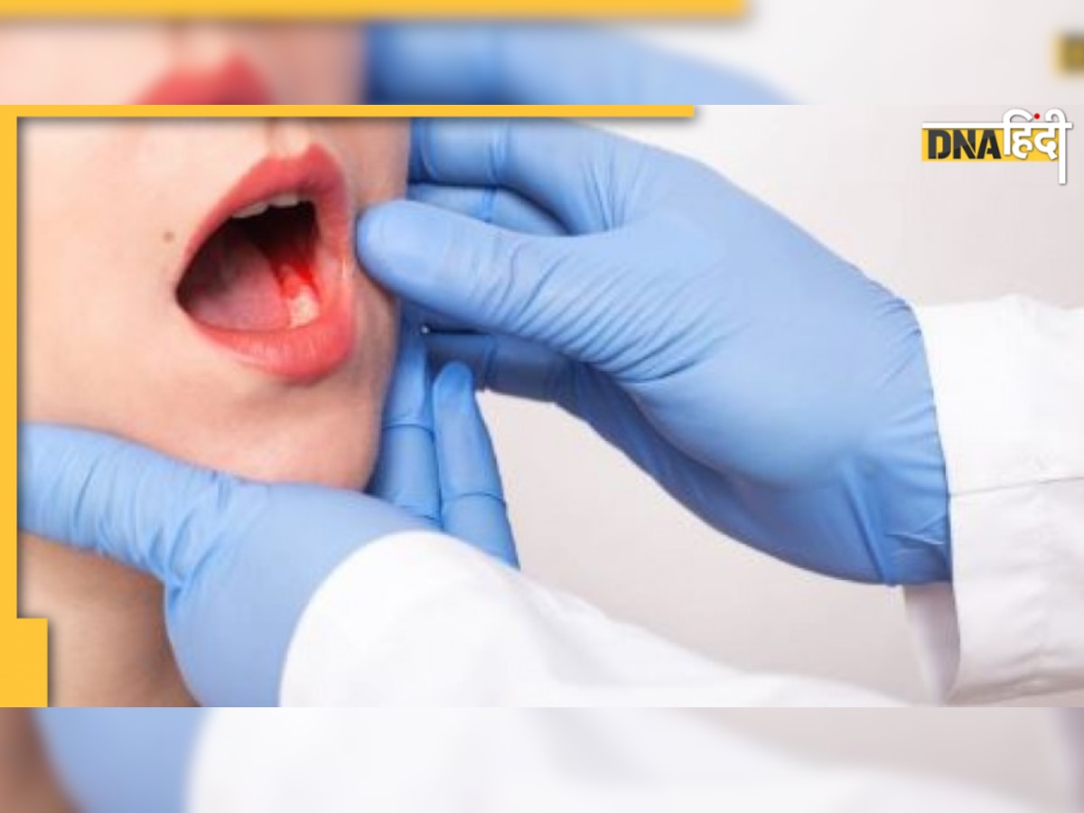 Oral Cancer: हर साल इस कैंसर से मरते हैं 75 हजार लोग, सभी Cancer में 11 फीसदी हैं इसके मामले