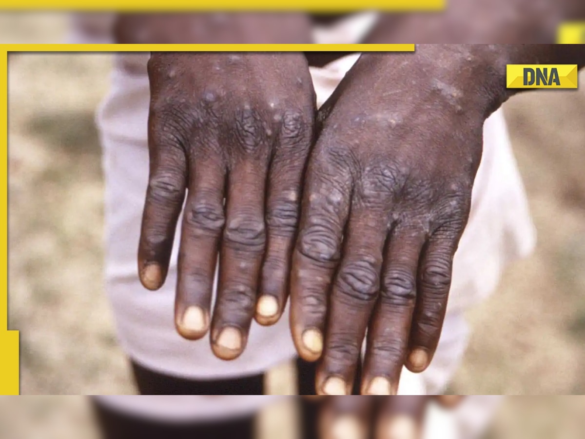 Delhi reports first case of monkeypox, 31-year-old man with no foreign travel history hospitalised