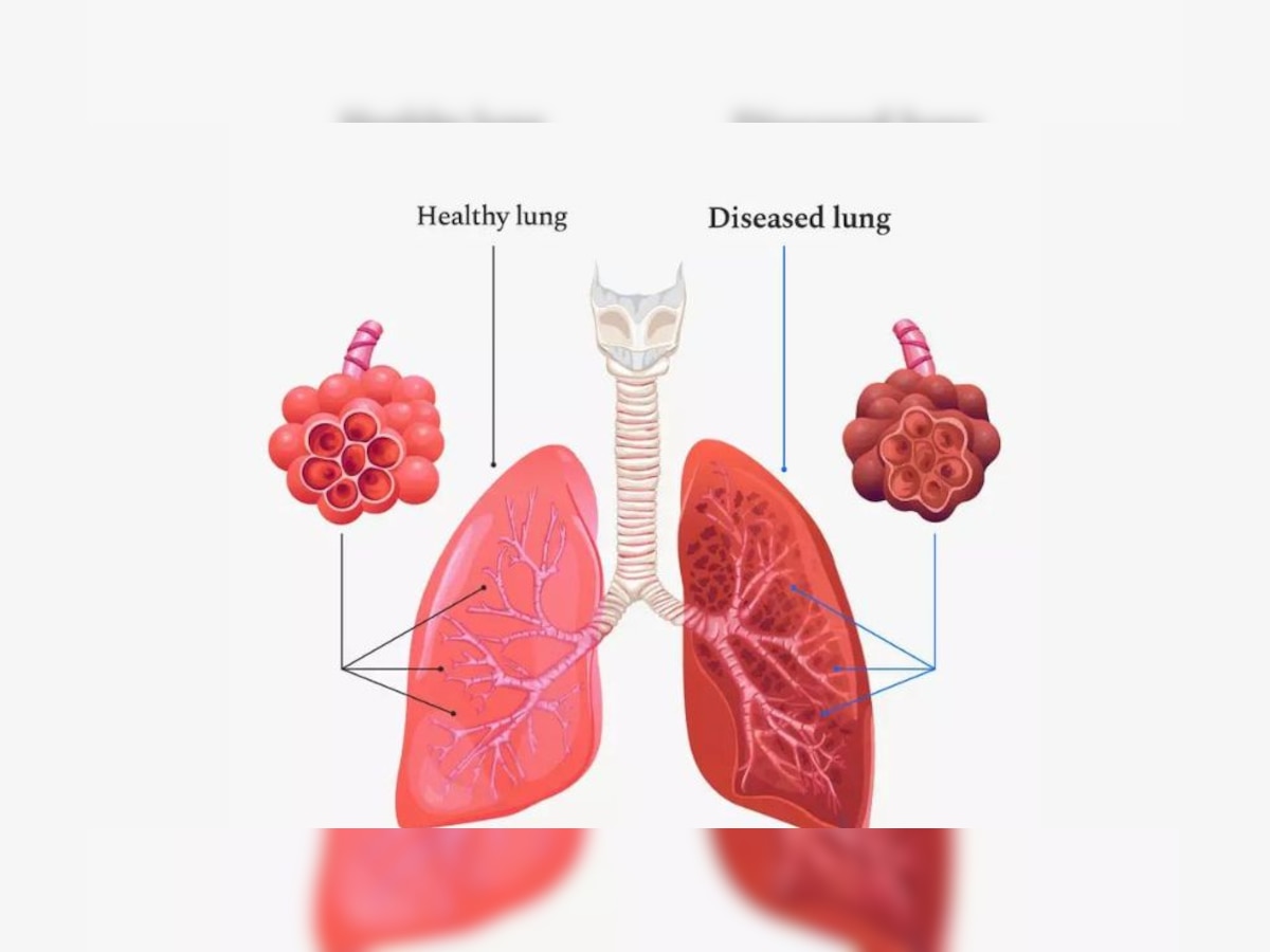 Acute Lung Disease: फेफड़े की गंभीर बीमारी है COPD, लंग्स की वीकनेस और सूजन से आजीवन रहेंगे खांसते, जान लें लक्षण