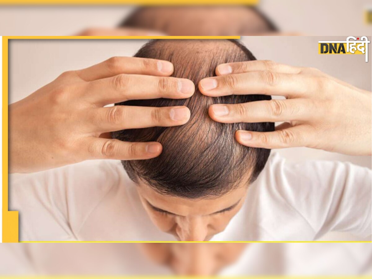 Baldness Medication: अमेरिका ने दी दवाई को मंज़ूरी, क्या अब मिलेगा गंजेपन यानी Alopecia Areata का इलाज?