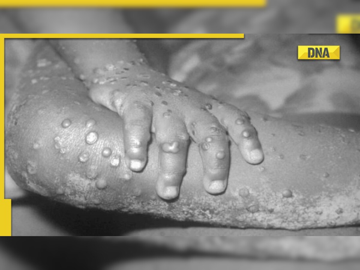 Monkeypox in India: Mandatory for all health facilities in Delhi to notify suspect cases