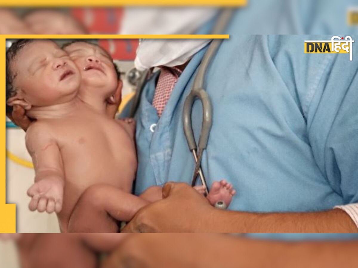 Conjoined Twins: क्या दो सिर और तीन पैर वाले जन्मे बच्चों को कोई बीमारी है? क्या है इसका इलाज