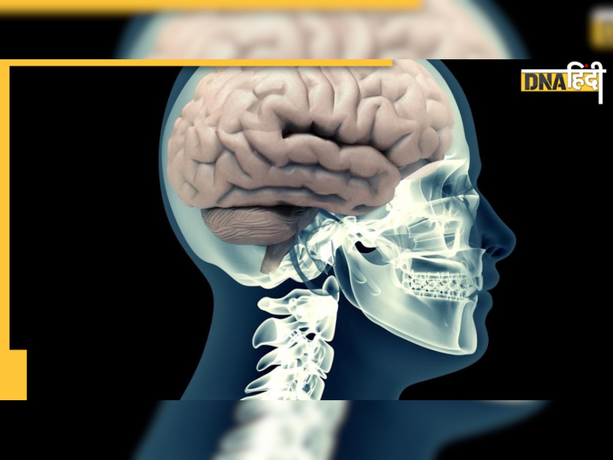 Brain Hemorrhage: दिमाग में लगी छोटी सी चोट बन सकती है खतरा, मस्तिष्क में कैसे जमते हैं खून के थक्के