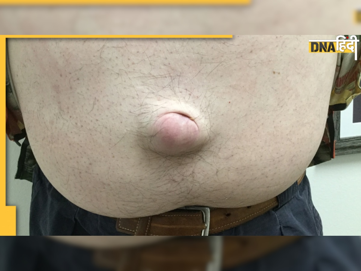 Hernia Symptoms: पेट में हल्का सा दर्द बन सकता है बड़ी बीमारी का कारण, जानें क्यों होती है हर्निया