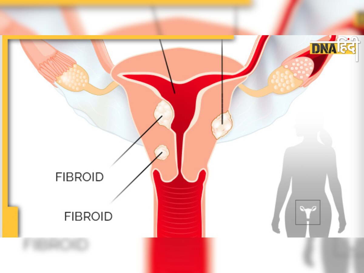 Uterine Fibroids: क्या आप भी जाते हैं बार-बार यूरिन, पीरियड्स में होती है ज्यादा Bleeding, तुरं��त चेक करें 