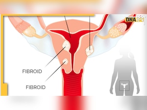 Uterine Fibroids: क्या आप भी जाते हैं बार-बार यूरिन, पीरियड्स में होती है ज्यादा Bleeding, तुरंत चेक करें 