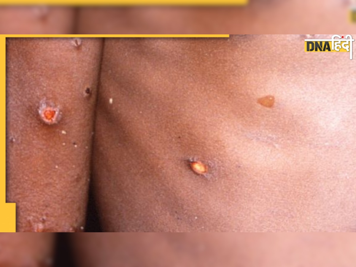 Monkeypox Delhi: मंकीपॉक्स से बचाव संभव, मरीज का इलाज करने वाली डॉक्टर ने बताया क्या करना होगा