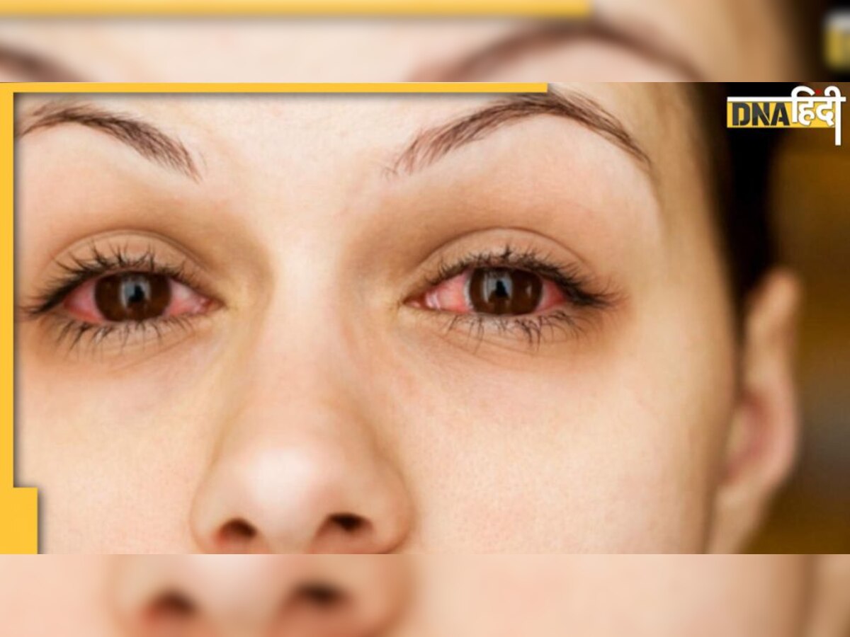 Health Tips: बरसात में Eye और Ear इंफेक्शन का बढ़ा खतरा, जानें लक्षण और बचाव