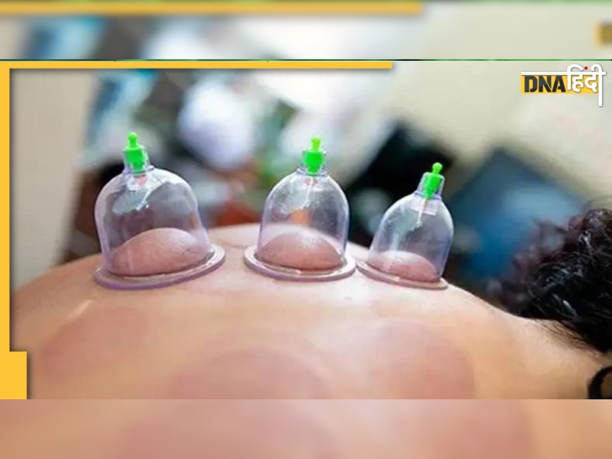 Cupping therapy: जोड़ाें के दर्द और जकड़न को दूर करती है कपिंग थैरेपी 