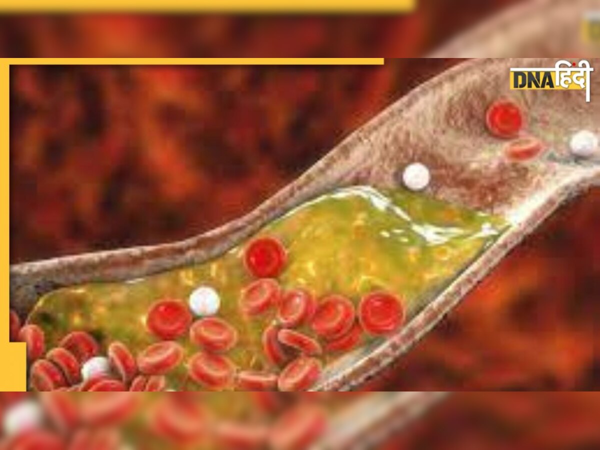 Good & Bad Cholesterol: कौन सा कोलेस्ट्रॉल देता है दिल की बीमारी के संकेत, क्या है LDL-HDL में फर्क