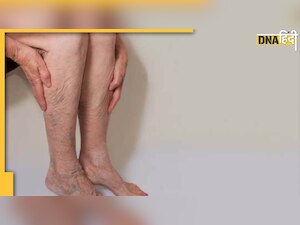 Nerves Problem: दबी नसों को खोल देंगे ये हर्ब्स और मसाले, हाई कोलेस्‍ट्रॉल वाले ध्‍यान दें