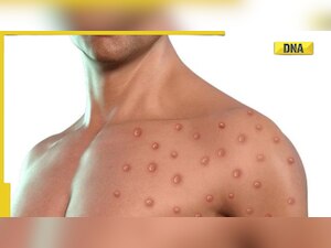 Monkeypox A.2 strain found in India: Symptoms and all you need to know
