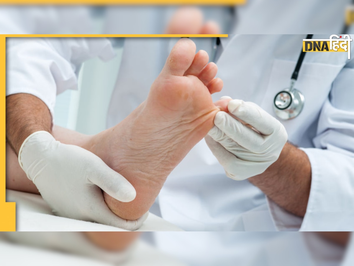 Diabetic Foot Care Tips: डायबिटीज मरीजों को पैर का रखना चाहिए खास खयाल, वरना हो सकती है यह घातक बीमारी 