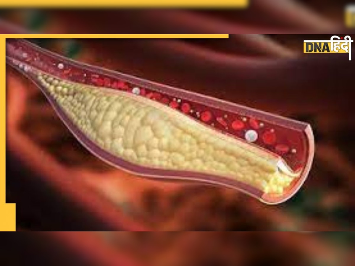 High Cholesterol: रात को दिखते हैं ये खतरनाक लक्षण, समझ लें बढ़ रहा खून में Fat का स्तर 