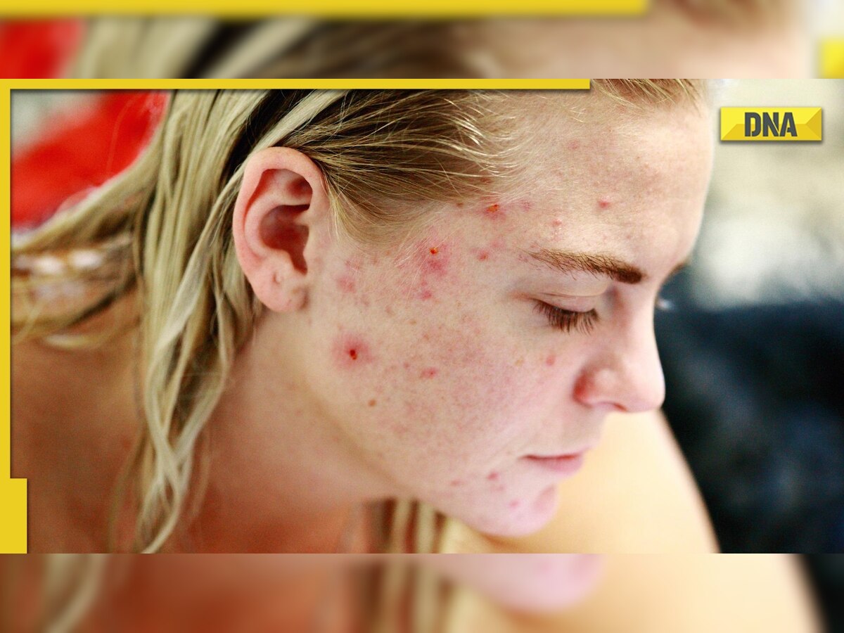 Skin Cancer:from types to treatments know allabout skin cancer