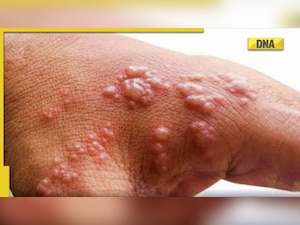 Monkeypox scare: 5th case of infection reported in Delhi, India's total tally reaches 10