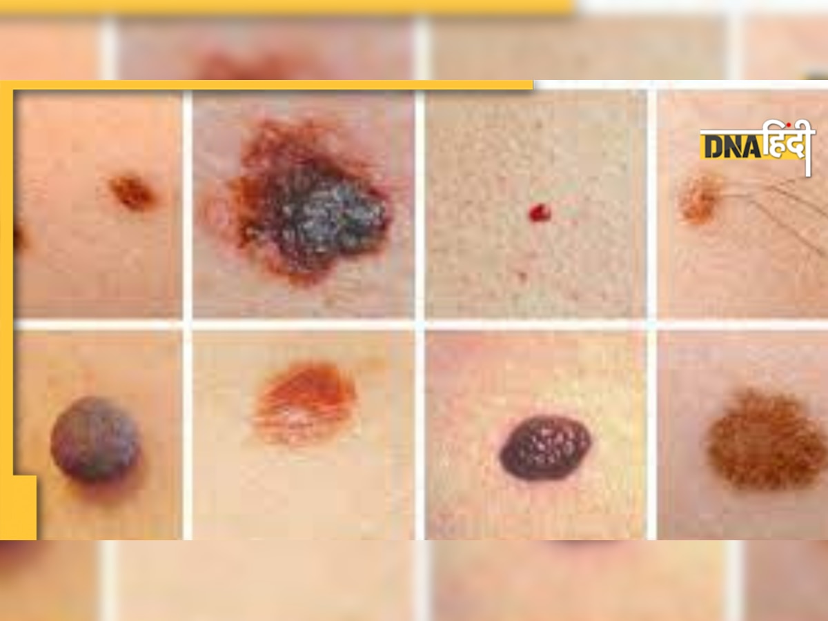 Skin Cancer: अगर त्वचा में बढ़ रहा है तिल का आकार तो हो जाएं सावधान, घर पर ही चेक करें कैं�सर है या नहीं 