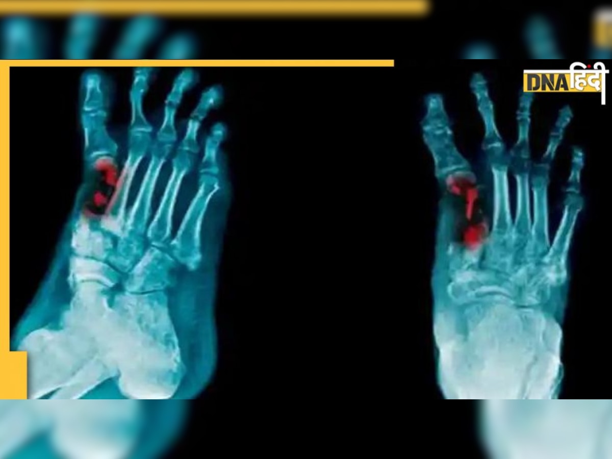 Bone Infection: हड्डियो��ं में इंफेक्शन होने पर भी होता है जोड़ों में दर्द, जानें इसके लक्षण