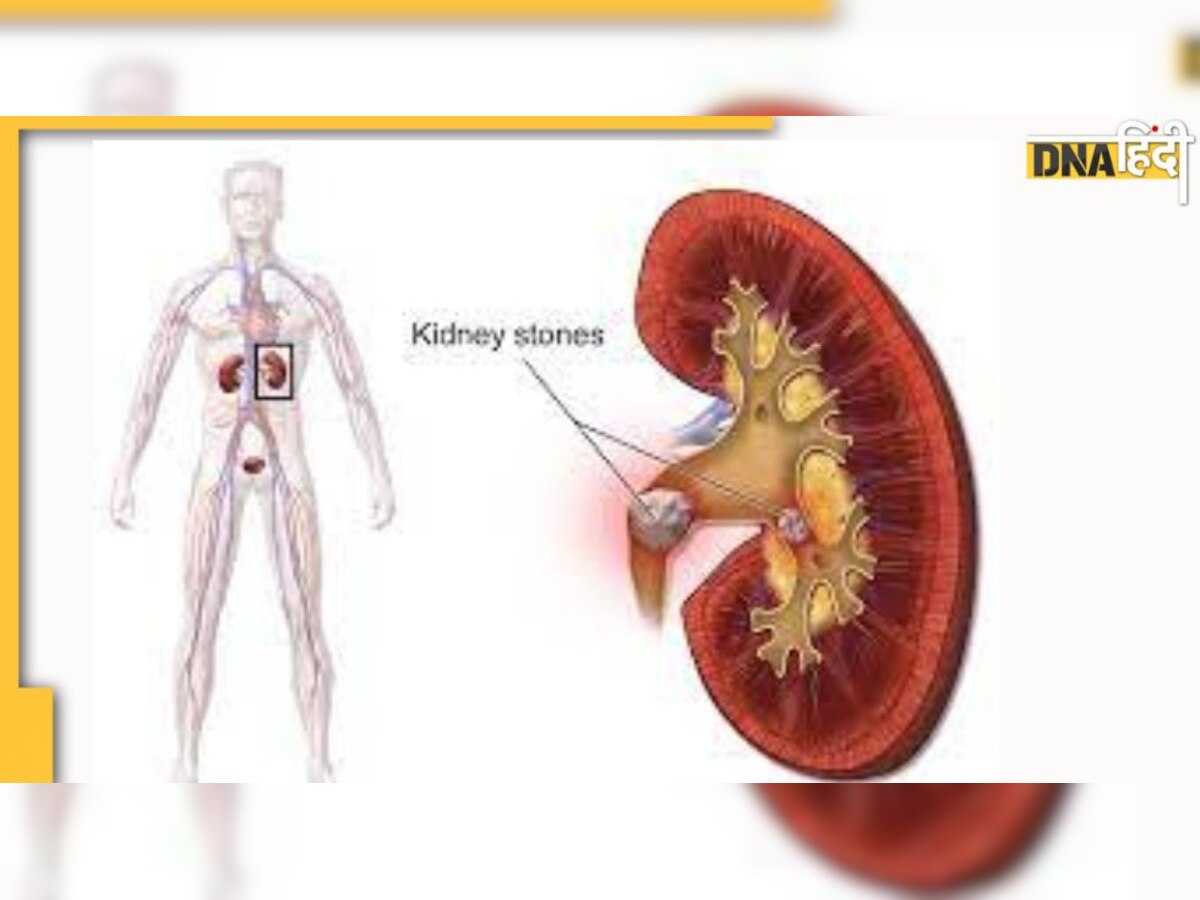 kidney stones : बड़ी से बड़ी पथरी को गलाकर बाहर कर देंगे ये घरेलू नुस्‍खे, नहीं करानी पड़ेगी सर्जरी