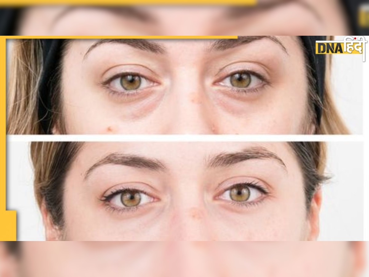 Eye Bags Removal: क्या आपके आंखों के नीचे भी है सूजन, क्या है यह समस्या, दूर करने के उपाय क्या हैं 