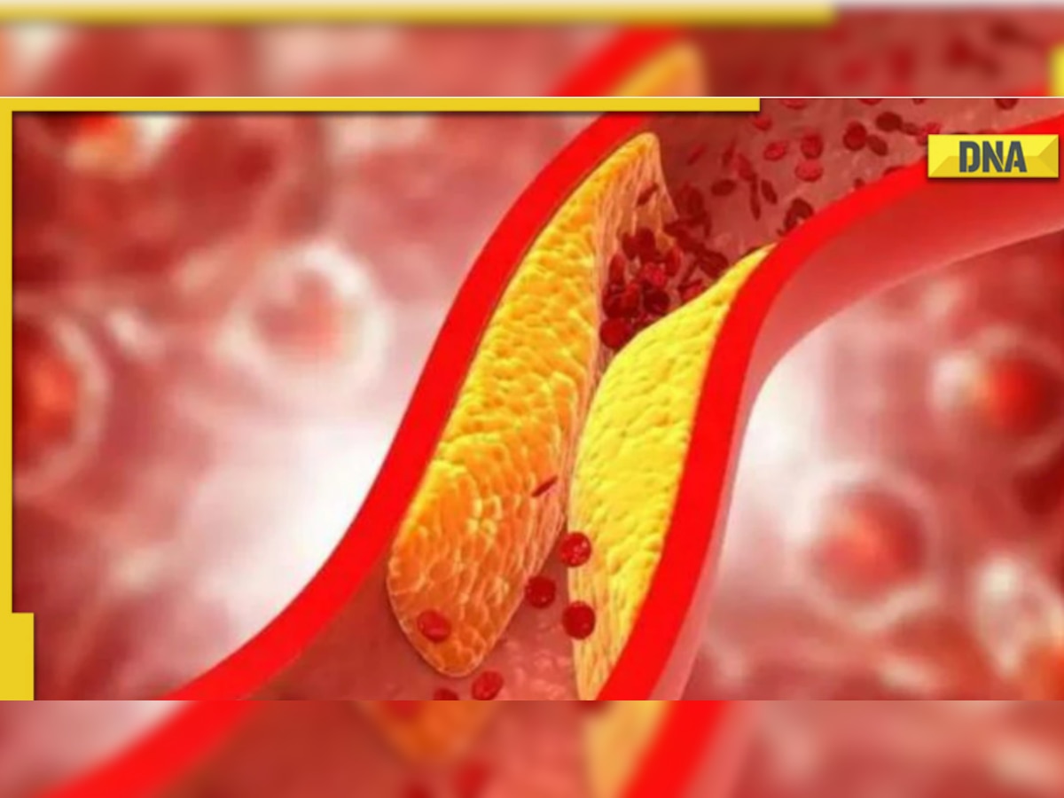 High cholesterol treatment: Know 5 natural ways to lower cholesterol levels 