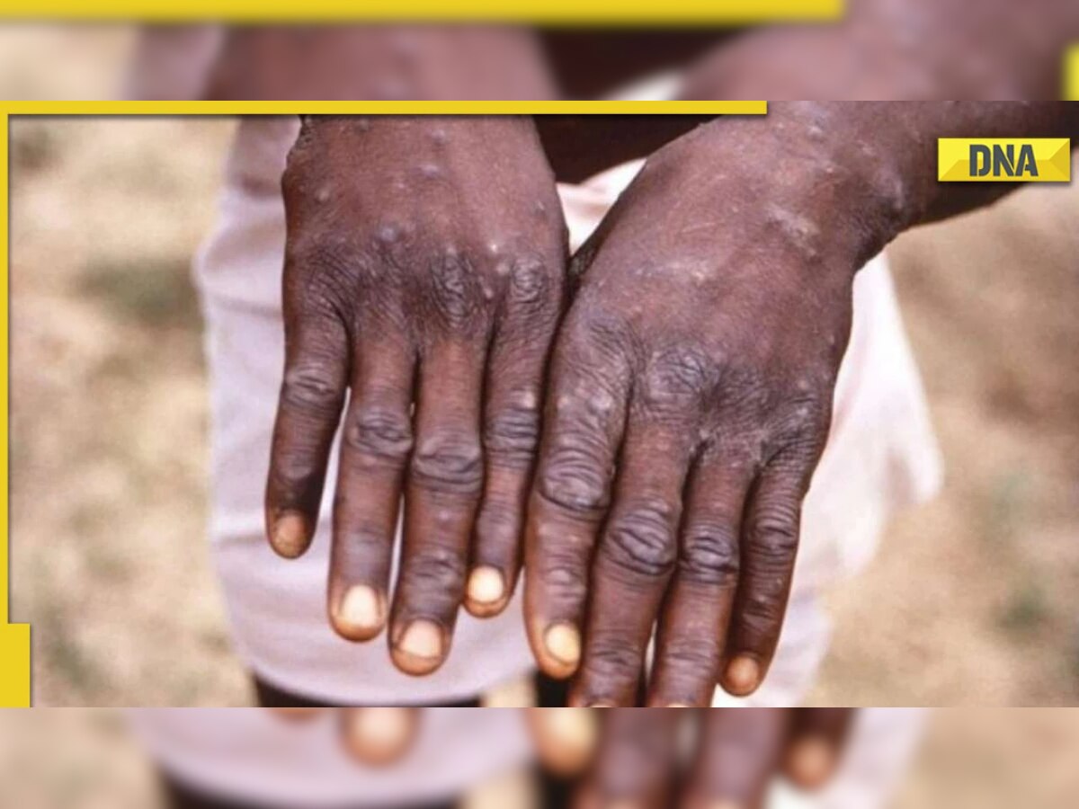 Monkeypox outbreak: 3 out of 5 cases in Delhi reveal no homosexual link, says ICMR