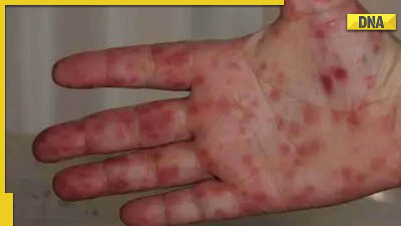 Hand, Foot And Mouth Disease: Symptoms To Watch Out For, Treatment