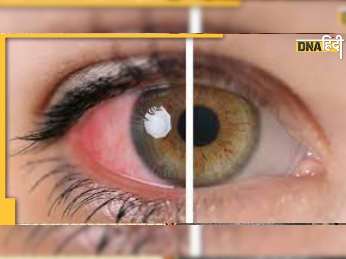Uveitis in Eyes: आम नहीं है आंखों की यह बीमारी, जानिए कैसे सूजन और जलन होती है, क्या है इलाज