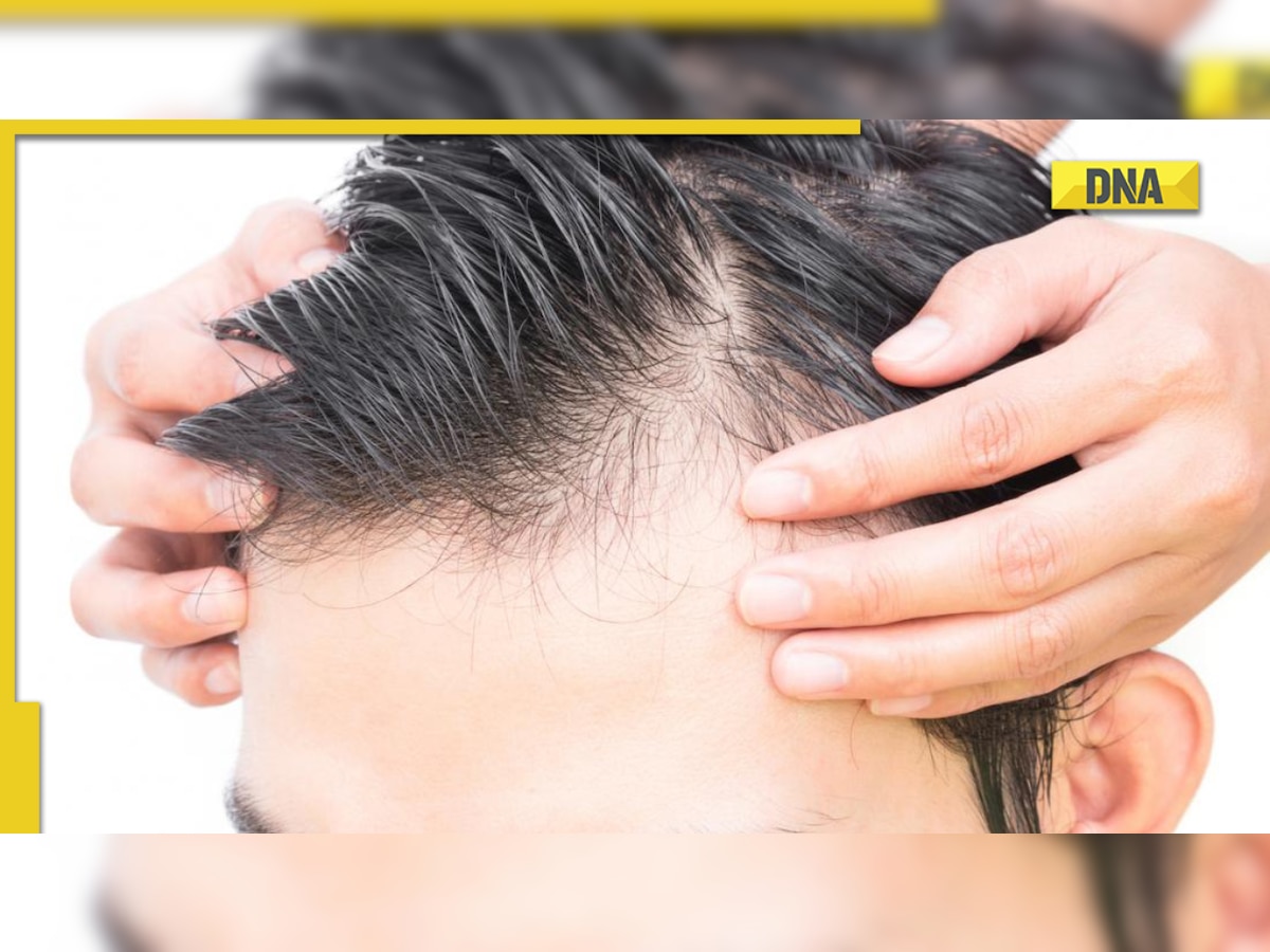 Male pattern baldness: Know its causes and treatment