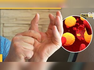 High Cholesterol Signs in Hands: हाथों में दर्द, झनझनाहट जैसे लक्षण करते हैं बैड कोलेस्ट्रॉल की ओर इशारा