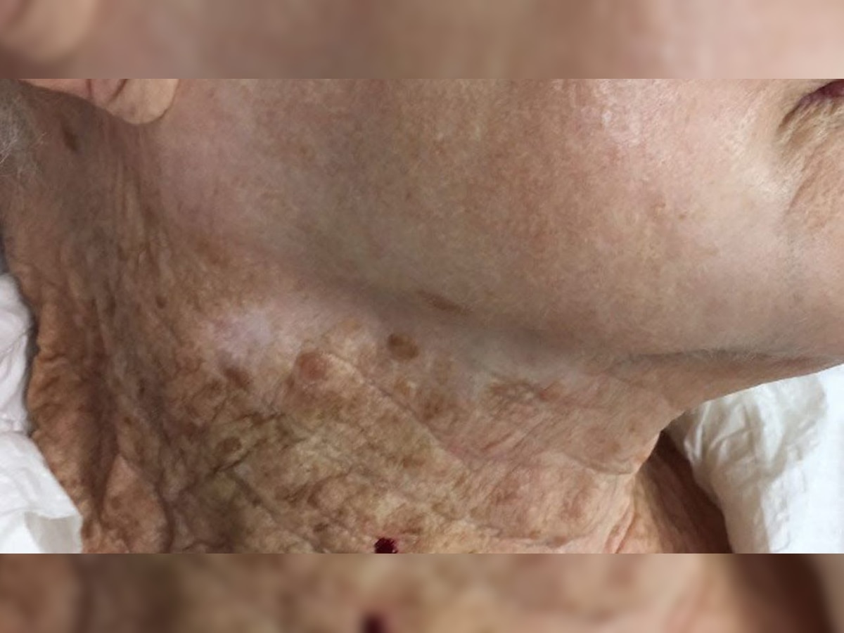 Woman uses SPF on her face and not on neck, photo of her damaged neck goes viral