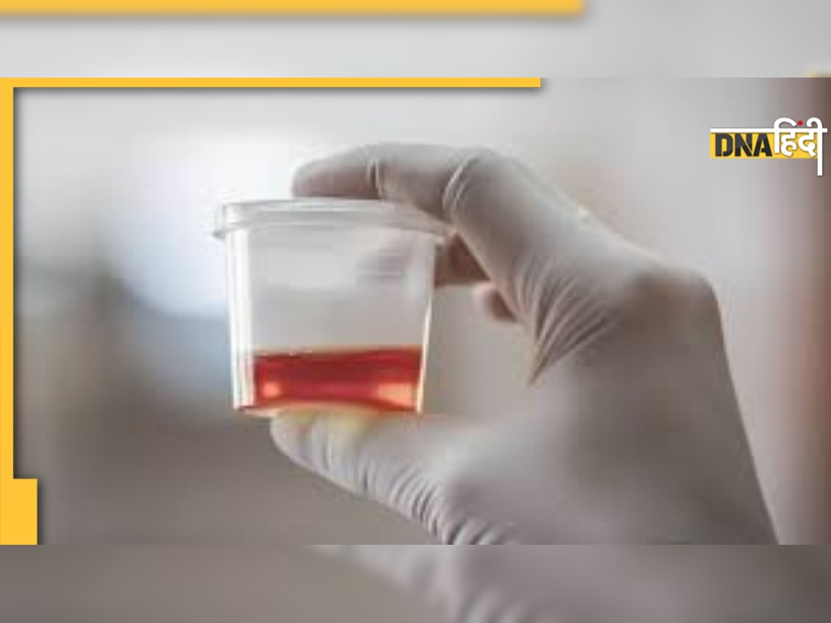 Blood in Urine: पेशाब का रंग लाल होना, क्या है यह बीमारी, जानिए कारण-लक्षण और इलाज