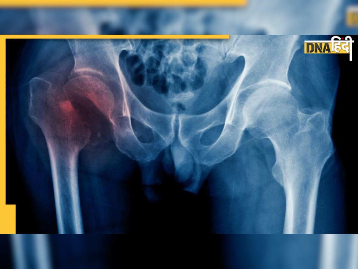  Hip Fracture: आने वाले 18 सालों में दोगुने लोग होंगे इसके शिकार, पुरुषों के कूल्हे टूटेंगे ज्यादा