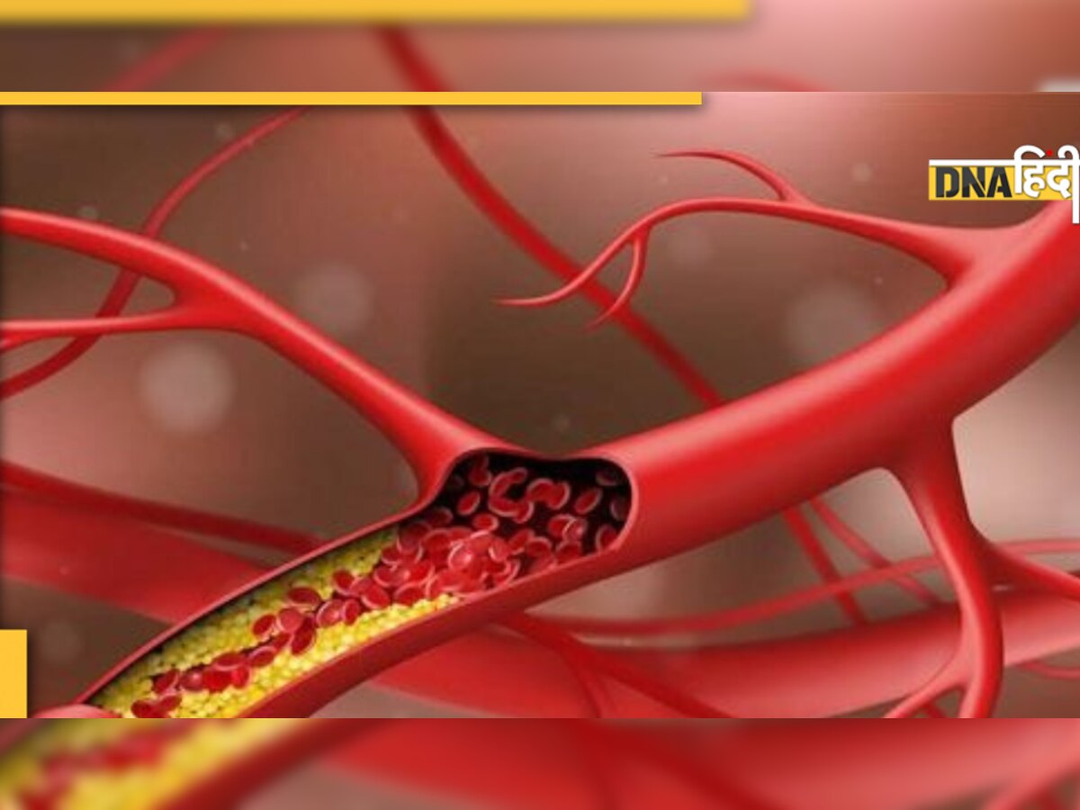 Pain in High Cholesterol: नसों में कोलेस्ट्रॉल बढ़ने से इन तीन हिस्सों में होता है दर्द, ऐसे पहचानें इसका बढ़ना